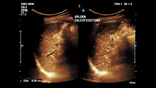 Lung InflammationGranuloma Problems with CGD [upl. by Mcconnell]