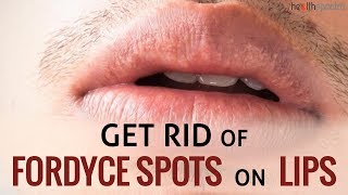 5 Best Ways to Remove Fordyce Spots Naturally at Home YouTube [upl. by Ettenil]