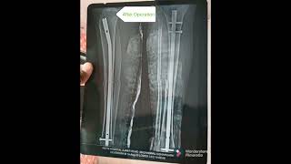 X Ray view of tibia Fibula Fracture recovery [upl. by Barabbas]