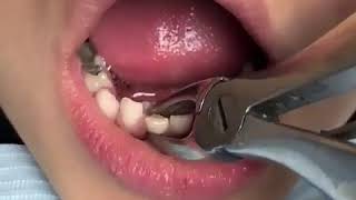 Deciduous Tooth Extraction [upl. by Heintz]