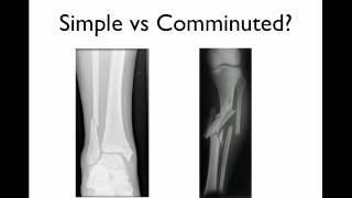 Surgical Fixation of Wrist Fractures [upl. by Ahsoyek]