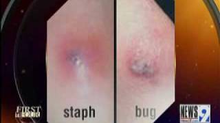 Bug Bites vs Staph Infections [upl. by Hanus]