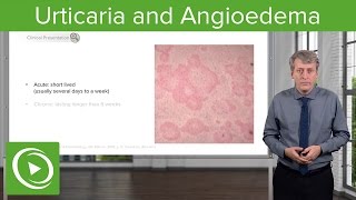 Urticaria Hives and Angioedema – Pediatrics  Lecturio [upl. by Mowbray146]