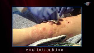 WCW Abscess Incision and Drainage [upl. by Idonah]