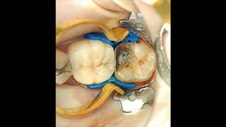 Restoring that broken molar and the difficult class II cavity [upl. by Nannie]