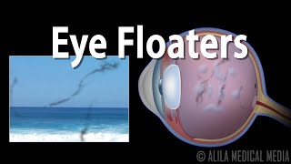 Eye Floaters and Flashes Animation [upl. by Durno]