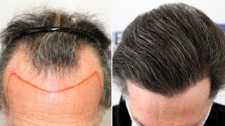 FUE Hair Transplant 4225 Grafts NW III Vertex By Dr Juan Couto  FUEXPERT CLINIC Madrid Spain [upl. by Marina418]