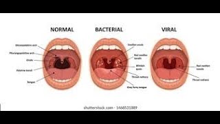 Pharyngitis Part 1 Viral Pharyngitis [upl. by Anead]