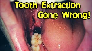 Wisdom Teeth Removal Extraction [upl. by Michele]