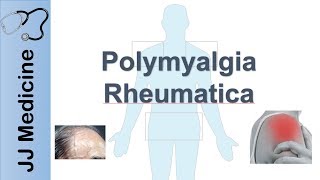 What is rheumatoid arthritis [upl. by Innavoj742]