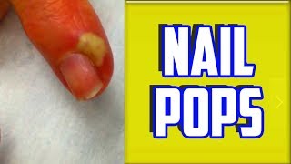 Top 4 Paronychia amp Nail Infections of All Time [upl. by Lennox]