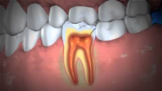 Treatment of Abscessed Teeth [upl. by Dorry98]