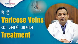 वैरीकोसेल का जड़ से इलाज  Varicocele Treatment [upl. by Ecneralc]