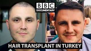 Hair Transplant Turkey  BBC Documentary  Paul Before amp After [upl. by Leyameg]