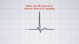 Interpreting ECG duration [upl. by Ernst148]