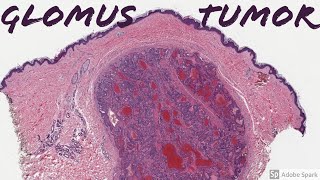 Glomus Tumor 5Minute Pathology Pearls [upl. by Lock]