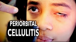 PERIORBITAL CELLULITIS Painful  Dr Paul [upl. by Irbua]