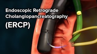 Primary Sclerosing Cholangitis PSC Care at Mayo Clinic [upl. by Alejo1]