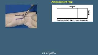 Simulation training for the perfect rotation flap [upl. by Enilreug]