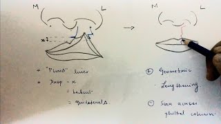 Allen  Bilateral Pedicle Flap Tunnel Technique [upl. by Novihc]