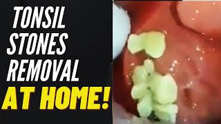 Tonsil Stones Removal Causes and Treatment [upl. by Daub489]