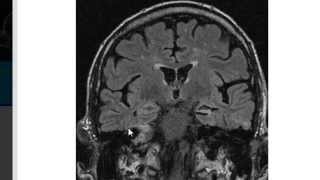 MRI in Epilepsy [upl. by Redep]