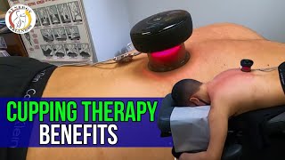 Cupping Therapy Benefits [upl. by Garnet524]