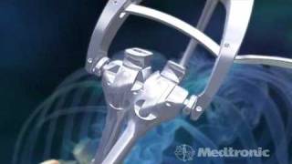 Medtronics Sextant  Minimally Invasive Spinal Fusion [upl. by Llenehc]