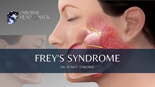 Freys Syndrome Information Prevention and Treatment Explained By Dr Ryan F Osborne [upl. by Ettennat]