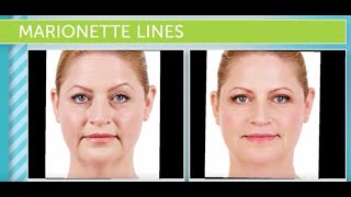 Treating Marionette Lines At Hermann Wellness [upl. by Rozalin]