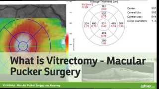 Vitrectomy  Macular Pucker Surgery and Recovery [upl. by Githens]