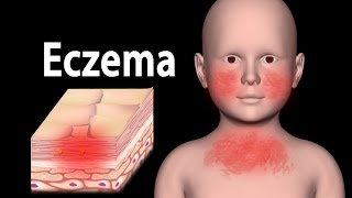 Eczema Animation [upl. by Irish]