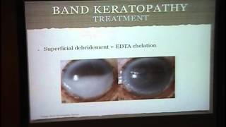 Band Keratopathy Interstitial Keratitis [upl. by Imat]