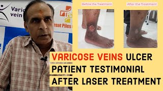 Treatment Of Varicose Veins  Surgery VS Laser  वैरिकोज वेन्स [upl. by Boyt]