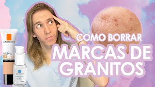 COMO BORRAR MARCAS DE ACNE de manera rápida y segura [upl. by Lorine]