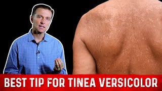 Natural Skin Fungus Tinea Versicolor Home Remedies – Dr Berg [upl. by Gnolb]