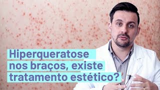 Tratamento estético para HIPERQUERATOSE NOS BRAÇOS  Pergunte 119 [upl. by Annavaig]