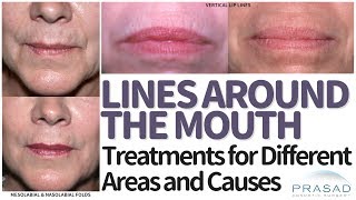 12 Ways To Get Rid Of Fordyce Spots On Lips  Healthspectra [upl. by Ahcim]