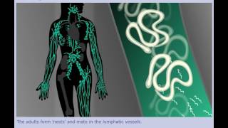 Lymphatic Filariasis Elephantiasis  Life Cycle [upl. by English]