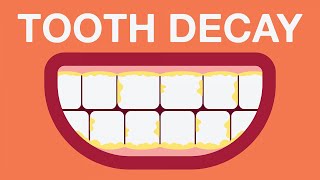 What causes tooth decay [upl. by Notyap500]