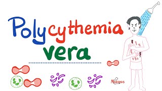 Polycythemia Vera PV  Myeloproliferative Neoplasm MPN  Erythrocytosis  Hematology [upl. by Hammad]