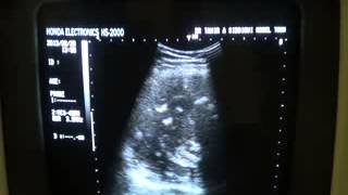 Solitary Pulmonary Nodule  Radiology Approach [upl. by Juliann]