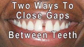 How to Close Gaps Between Teeth [upl. by Vories]