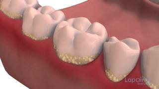 Decay formation  Lapointe dental centres [upl. by Citarella598]