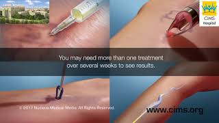 Varicose Veins Treatment Procedure by Dr Jaisom Chopra [upl. by Nitneuq]