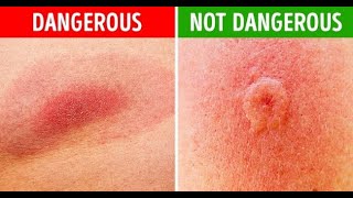 How to Identify Common Bug Bites [upl. by Adleme]