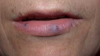 Fordyce Spots white yellow bumps over lips and cheek Should I worry [upl. by Intisar245]