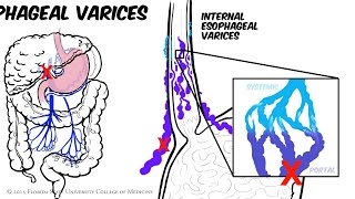 Portal Hypertension Animated Review [upl. by Innes469]