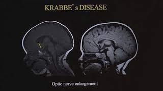 TMT Neuroradiology by Dr Deepak Patkar Ped White Matter Diseases  II [upl. by Benkley]