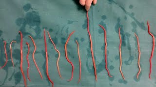 Doctors Remove 14 Roundworms From Woman [upl. by Mikey40]